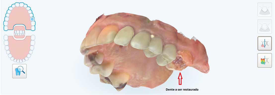 Escaneamento pelo iTero para confecção de restauração onlay-pelo-iTero-para-confecção-de-restauração-onlay- Escaneamento pelo iTero para confecção de restauração onlay