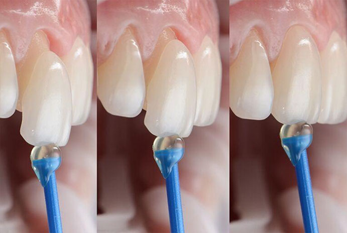 Facetas e lentes de contato dental Facetas e lentes de contato dental