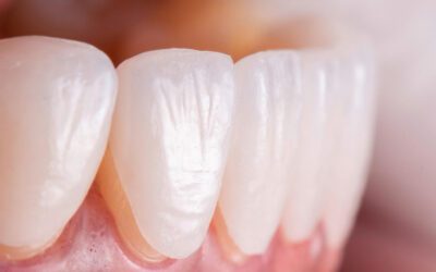 Ortodontia e estética dental: por que alinhar com Invisalign antes de colocar facetas ou lentes de contato