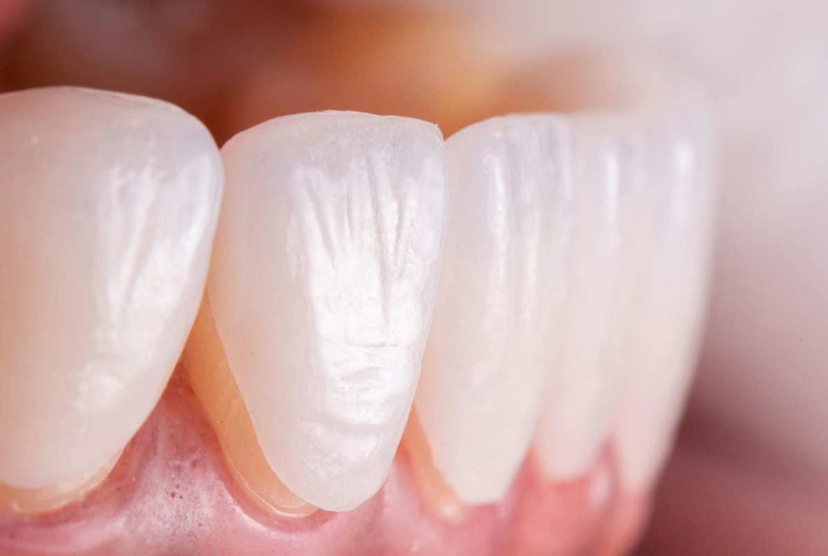 Ortodontia e estética dental: por que alinhar com Invisalign antes de colocar facetas ou lentes de contato Ortodontia e estética dental: por que alinhar com Invisalign antes de colocar facetas ou lentes de contato