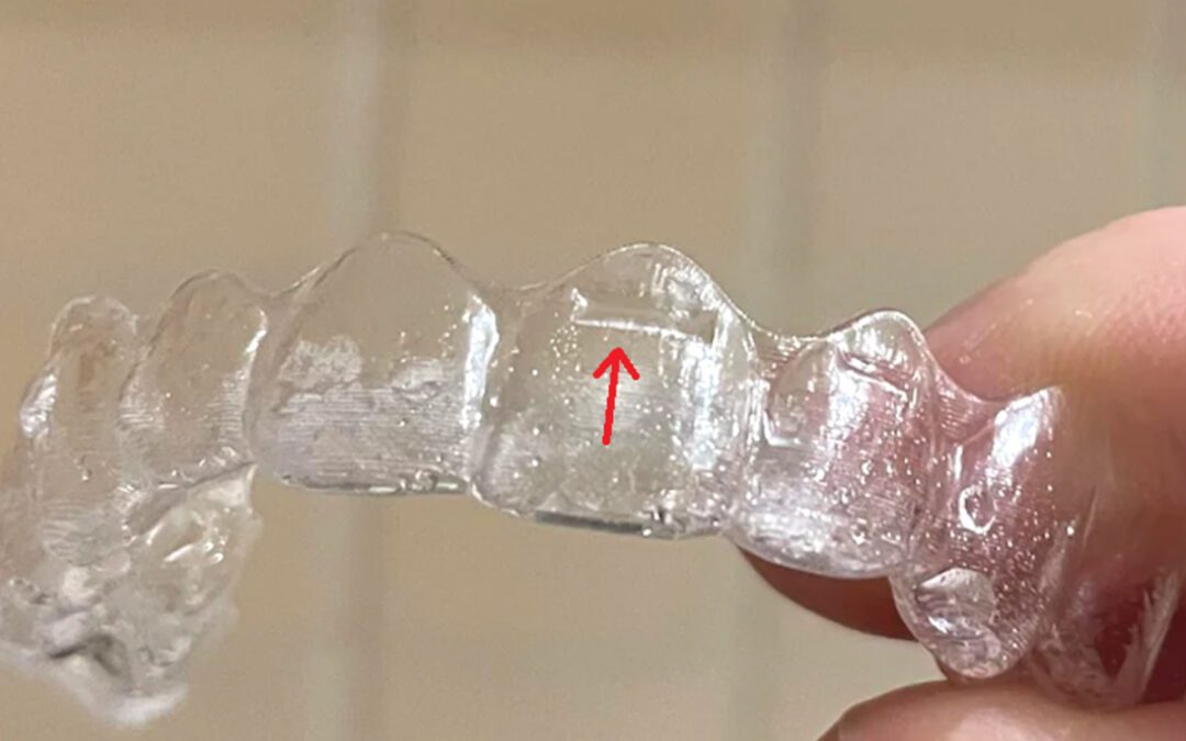 Power Ridges no Invisalign: o que são e como ajudam na movimentação dentária