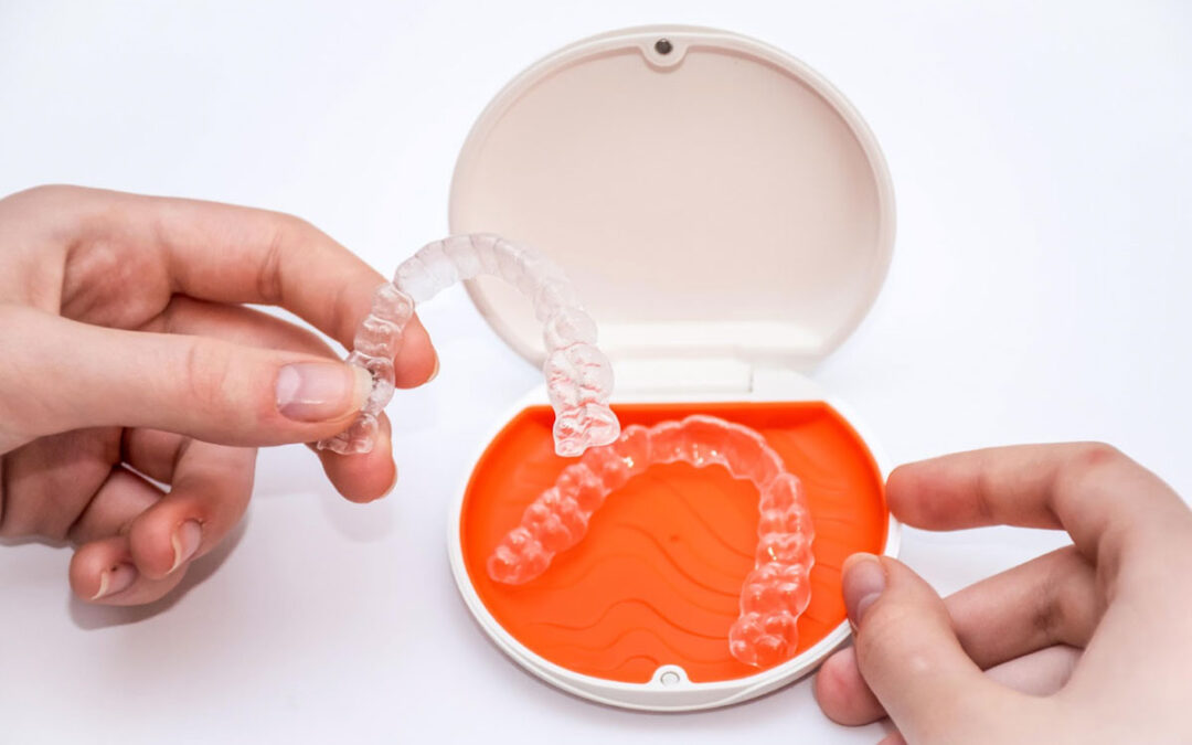 Preciso remover os attachments para usar a contenção Vivera da Invisalign?