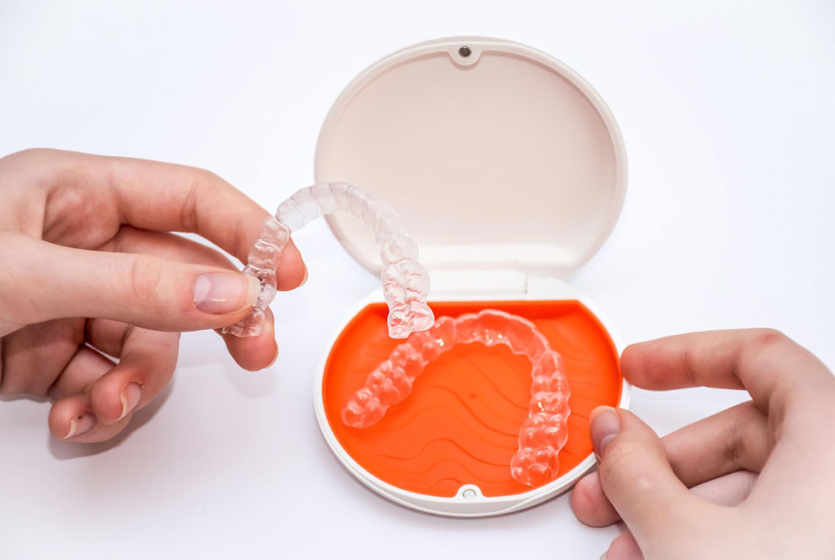 Preciso remover os attachments para usar a contenção Vivera da Invisalign? Preciso remover os attachments para usar a contenção Vivera da Invisalign?