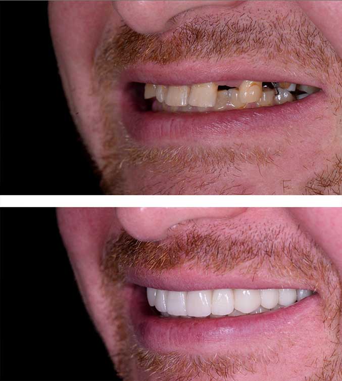 Resultado após a reabilitação oral Resultado após a reabilitação oral<br />