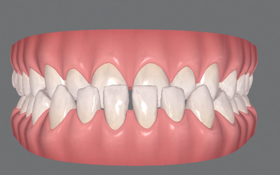 Tenho Classe III. Posso usar Invisalign?