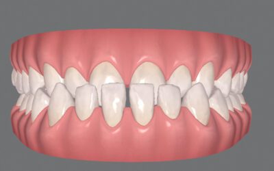 Tenho Classe III. Posso usar Invisalign?