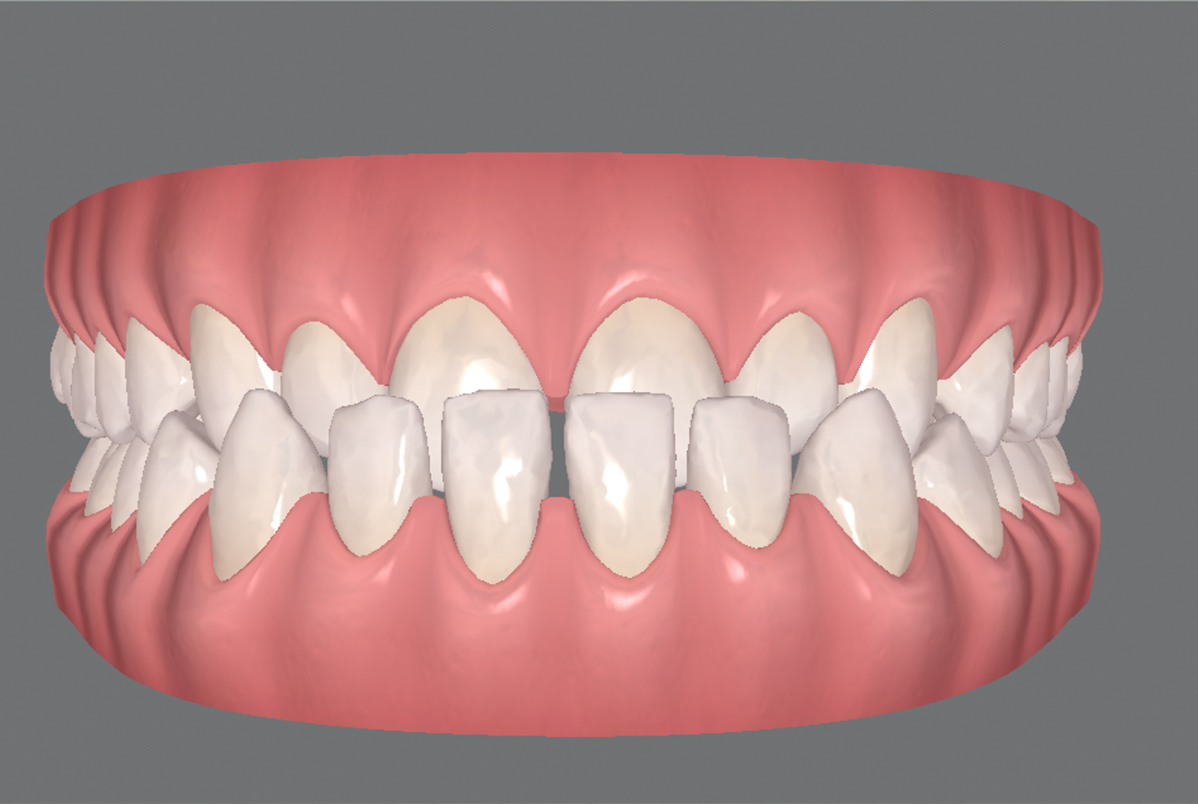 Tenho Classe III. Posso usar Invisalign? Tenho Classe III. Posso usar Invisalign?<br />