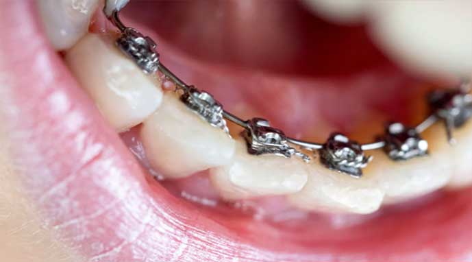 aparelho lingual aparelho lingual