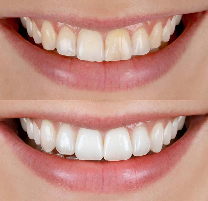 Lente de Contato Dental Lente de Contato Dental