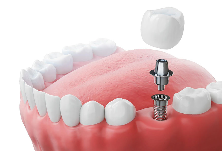 3. Próteses sobre implantes 3. Próteses sobre implantes