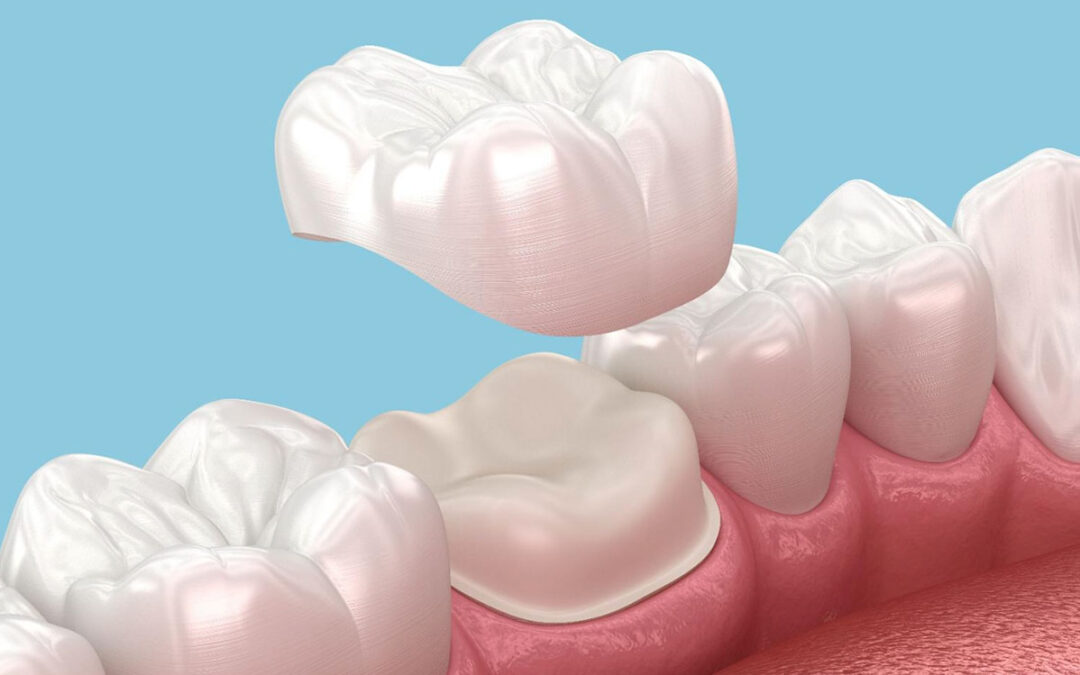 Coroas dentárias: o que são, quando usar e quais os tipos disponíveis