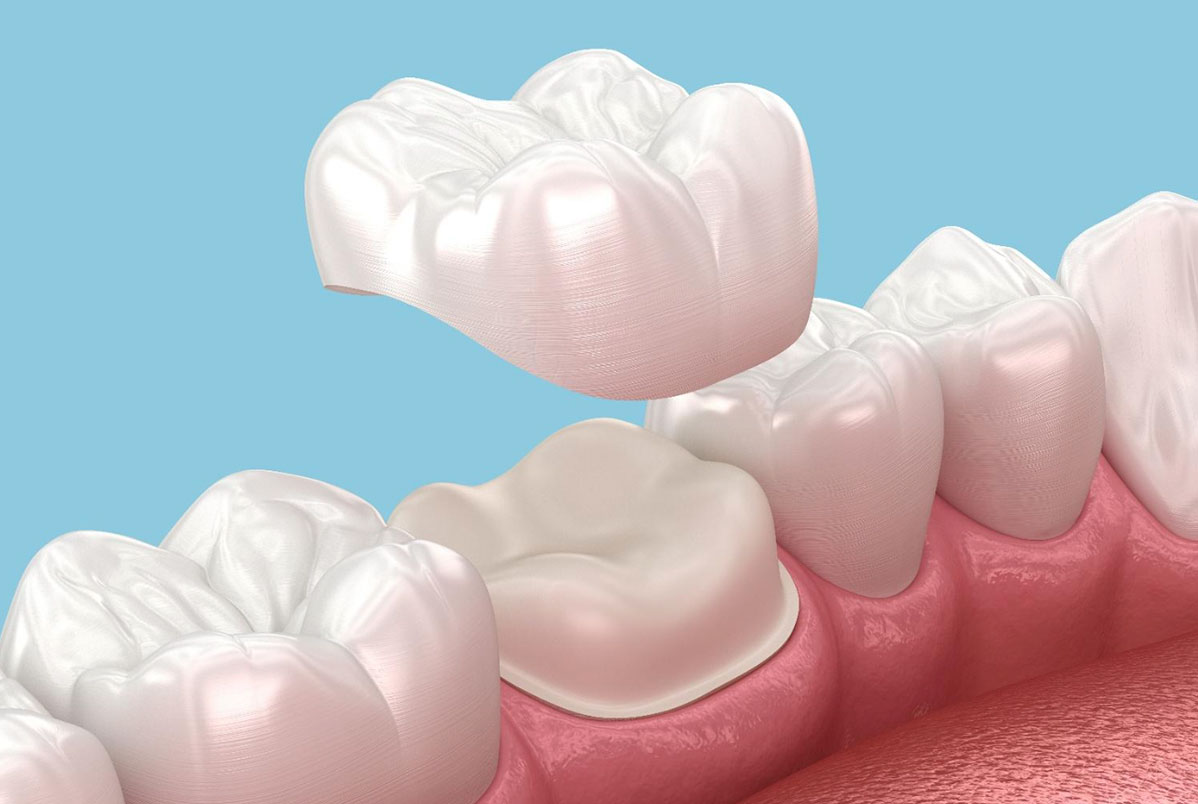 Coroas dentárias: o que são, quando usar e quais os tipos disponíveis