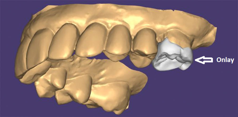 Exemplo de uma restauração onlay pelo planejamento digital Exemplo de uma restauração onlay pelo planejamento digital