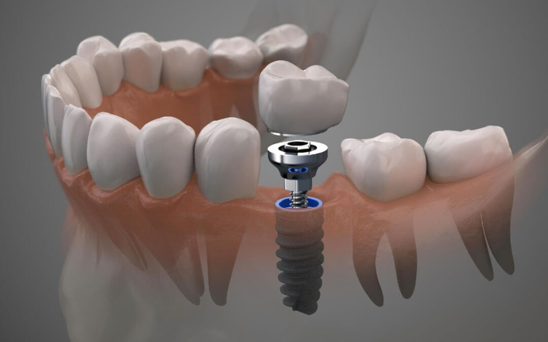 O que são próteses dentárias e quando elas são indicadas?