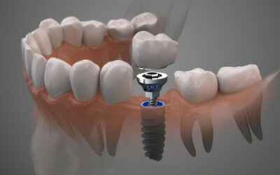 O que são próteses dentárias e quando elas são indicadas?