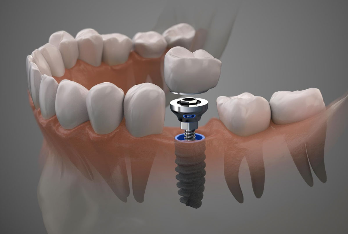 O que são próteses dentárias e quando elas são indicadas? O que são próteses dentárias e quando elas são indicadas?