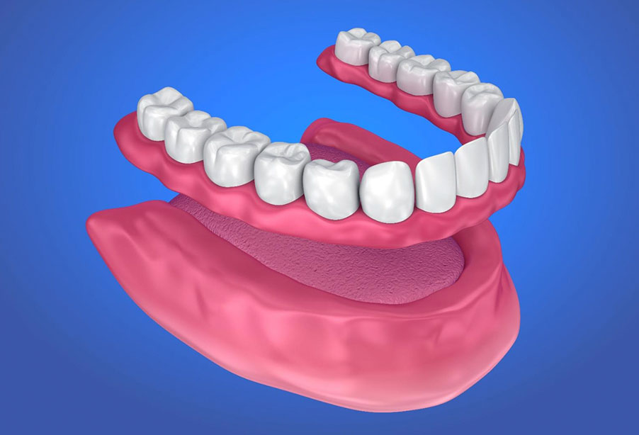 Próteses totais (dentaduras): indicadas para pacientes que perderam todos os dentes de uma arcada. Próteses totais (dentaduras): indicadas para pacientes que perderam todos os dentes de uma arcada.