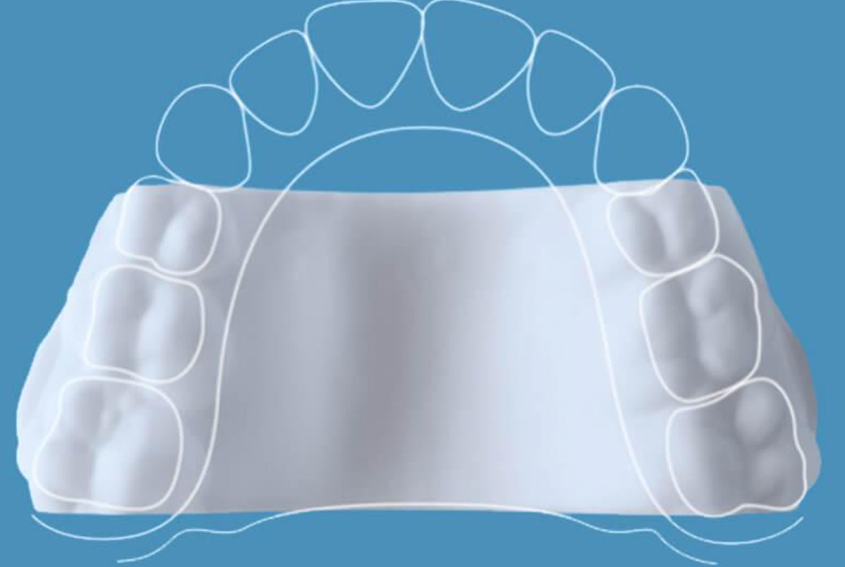 Invisalign Palatal Expander: o que é, como funciona e quando é indicado