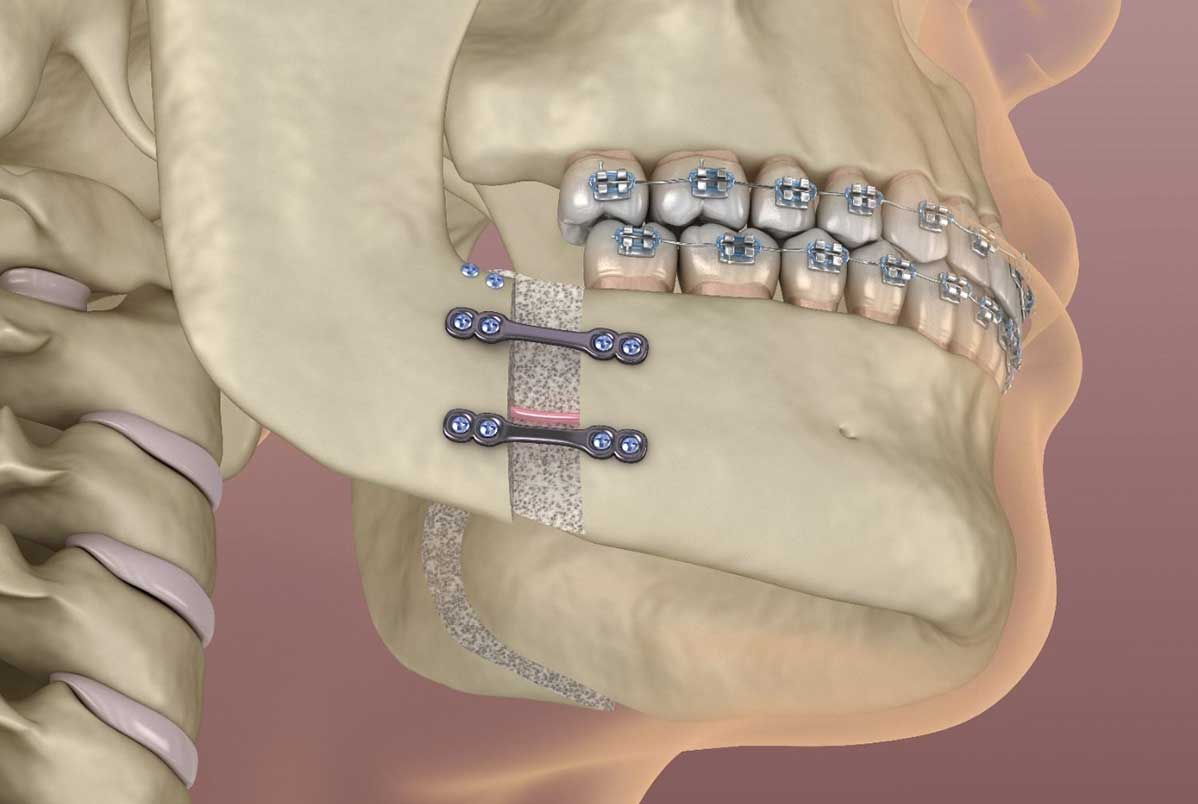 Invisalign pode evitar uma cirurgia ortognática?