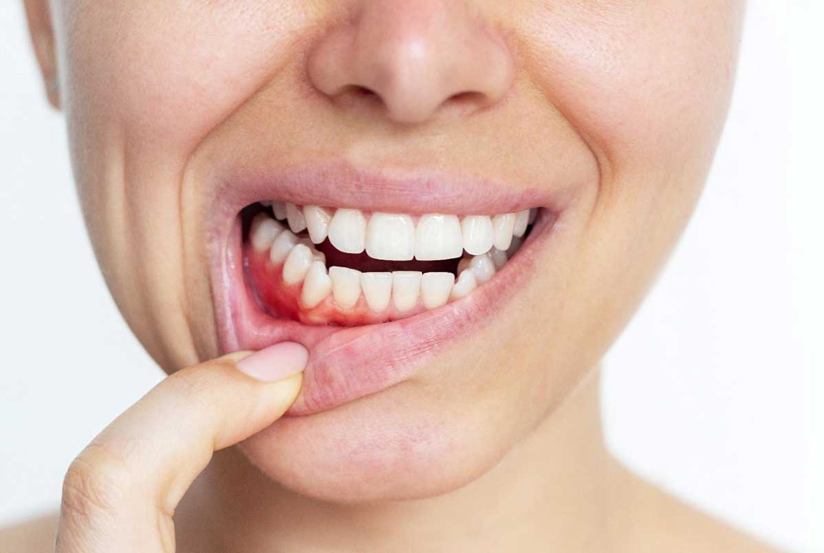 Terapia fotodinâmica no tratamento da gengivite