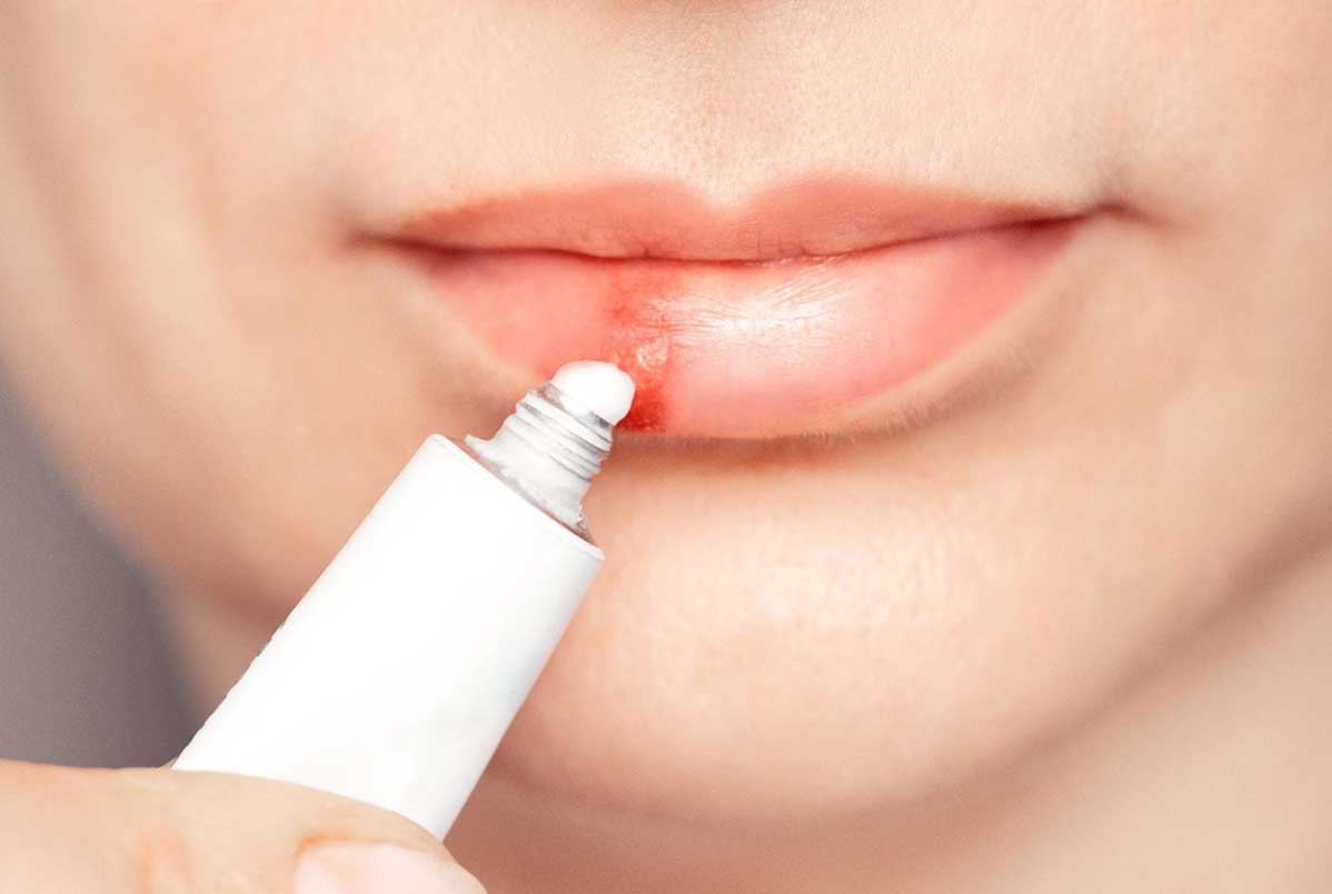 Uso do laser de baixa potência no tratamento da herpes labial