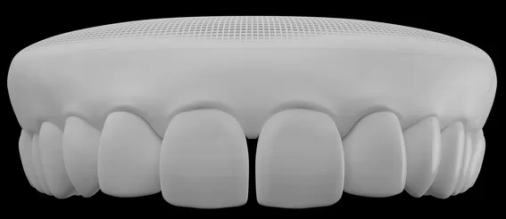 Planejamento do tratamento sem attachments (movimentação será promovida apenas pelo alinhador)