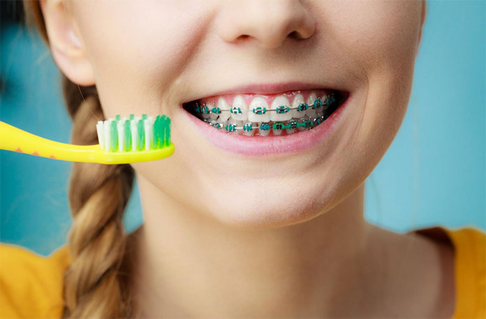 Aparelho fixo convencional com bráquetes e fios metálicos