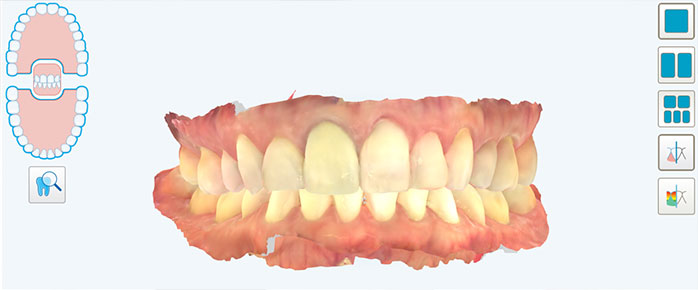 Escaneamento intraoral<br />

