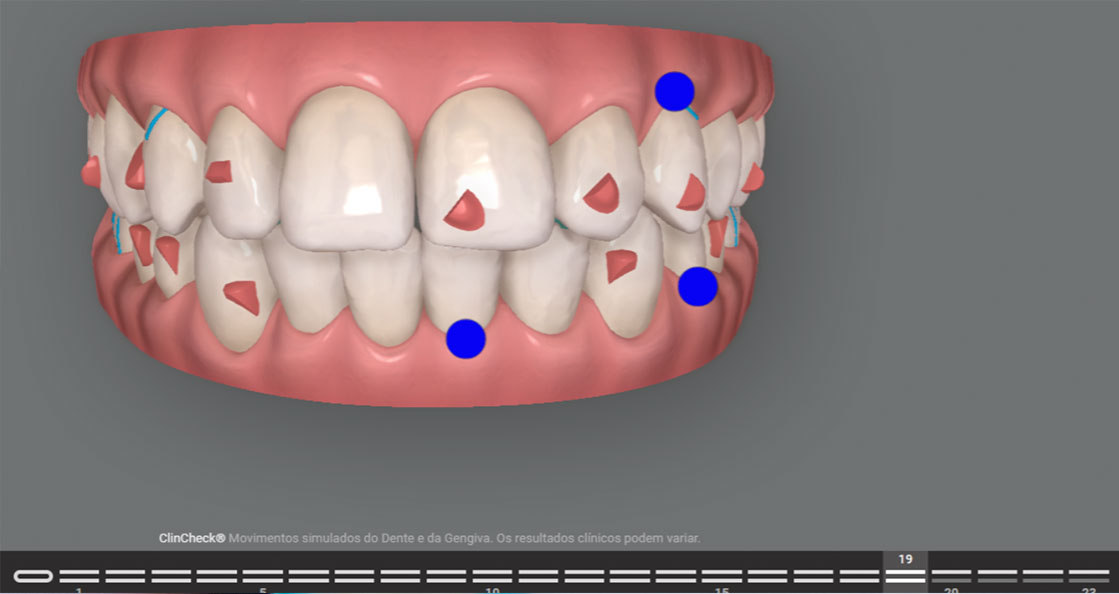 Exemplo de uso de alinhadores passivos (20 a 23) no planejamento ortodôntico com Invisalign
