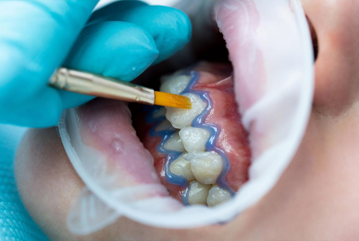 Laser de baixa potência no clareamento dental para pacientes com sensibilidade