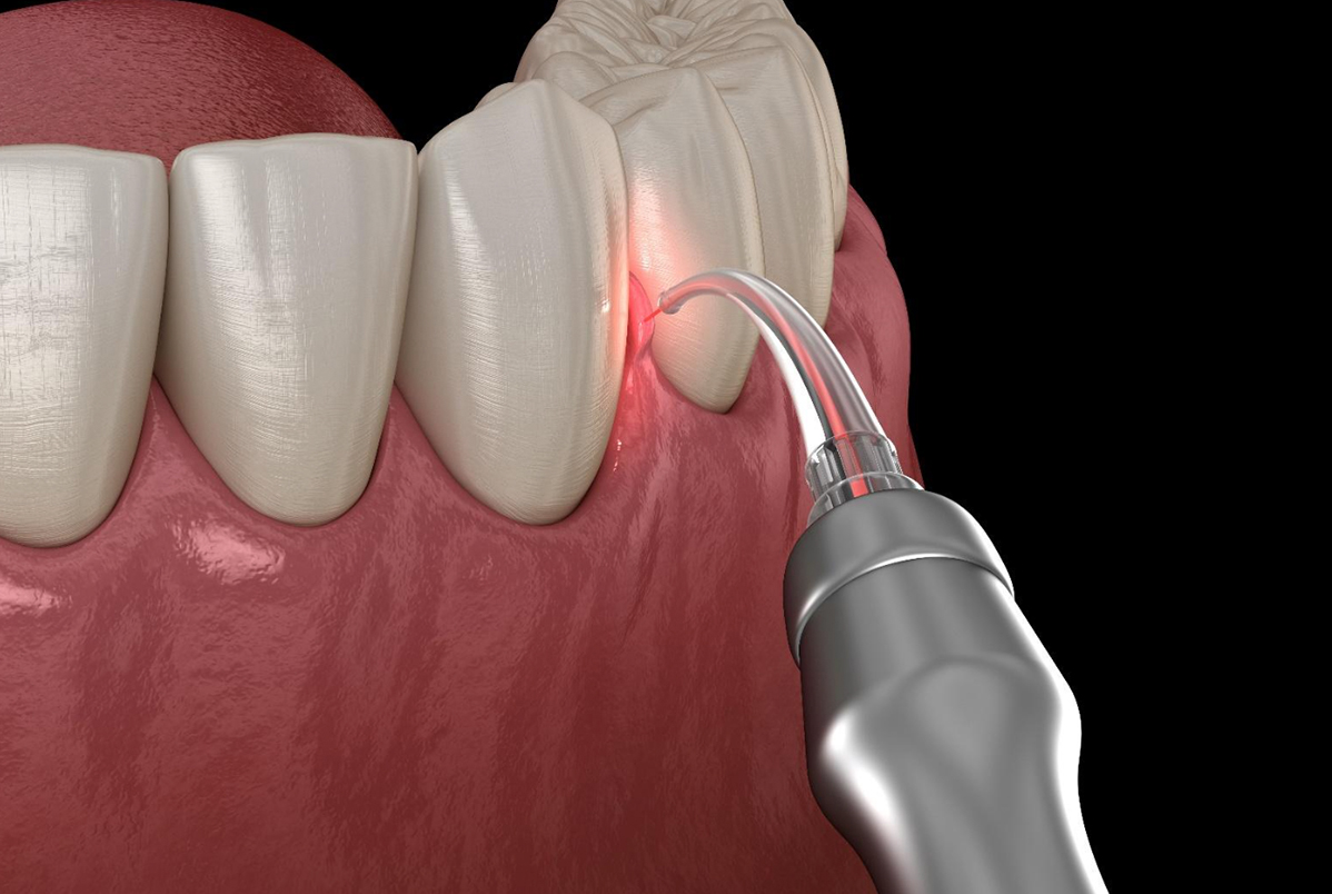 Laser de baixa potência odontológico dói? O que o paciente sente durante o tratamento