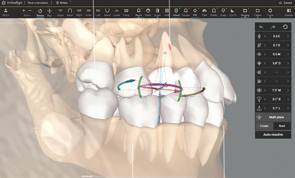 Tomografia integrada ao planejamento ortodôntico com alinhadores Invisalign