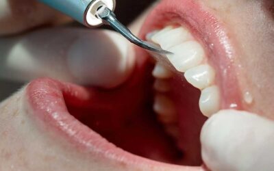 Conforto e ciência na profilaxia (limpeza dental) odontológica moderna