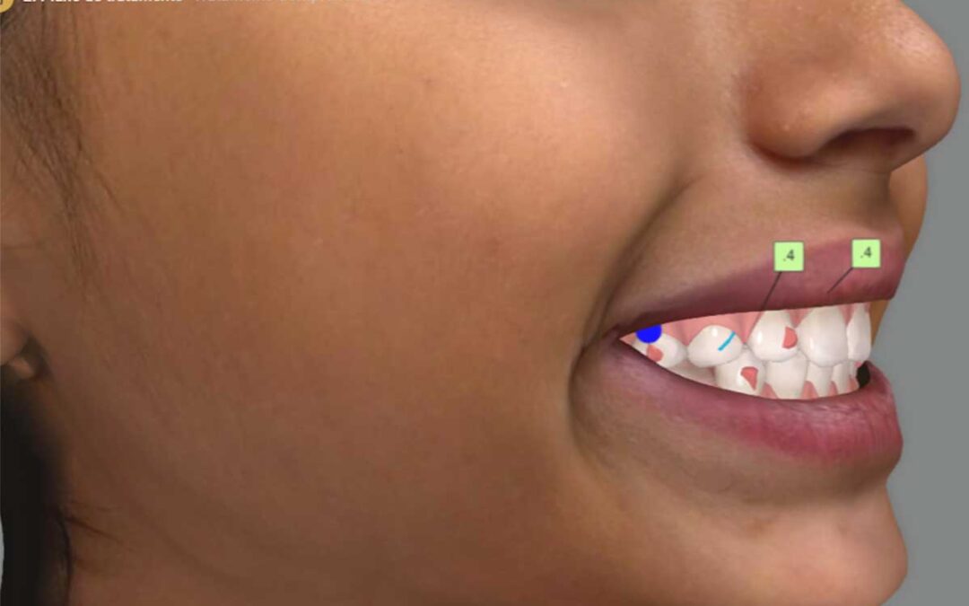 Escaneamento Facial 3D no tratamento com Invisalign