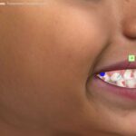 Escaneamento Facial 3D no tratamento com Invisalign