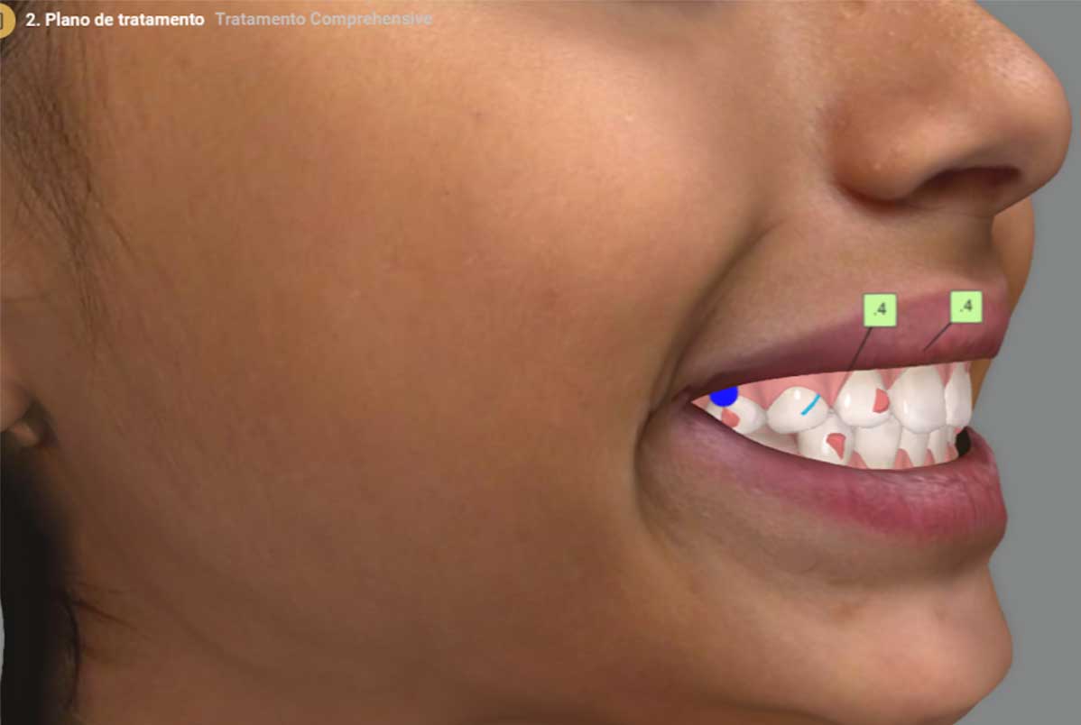 Escaneamento Facial 3D no tratamento com Invisalign
