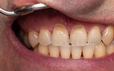 O que são lesões não cariosas e por que são cada vez mais frequentes?