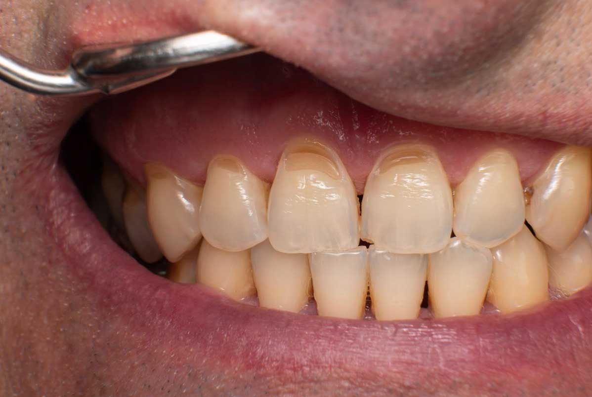 O que são lesões não cariosas e por que são cada vez mais frequentes?