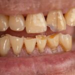 Tratamentos de lesões não cariosas: como recuperar dentes desgastados com segurança e naturalidade