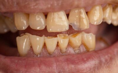 Tratamentos de lesões não cariosas