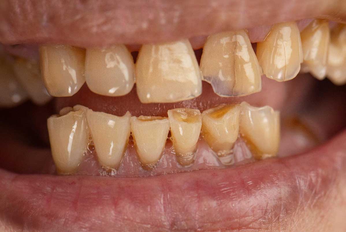 Tratamentos de lesões não cariosas: como recuperar dentes desgastados com segurança e naturalidade
