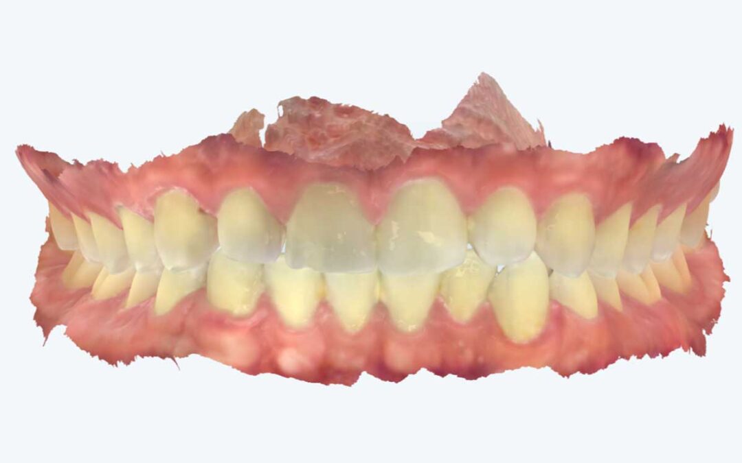 Uso do escaneamento intraoral na limpeza dental com AirFlow