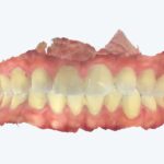 Uso do escaneamento intraoral na limpeza dental com AirFlow