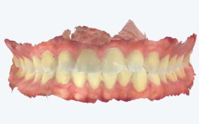 Uso do escaneamento intraoral na limpeza dental com AirFlow