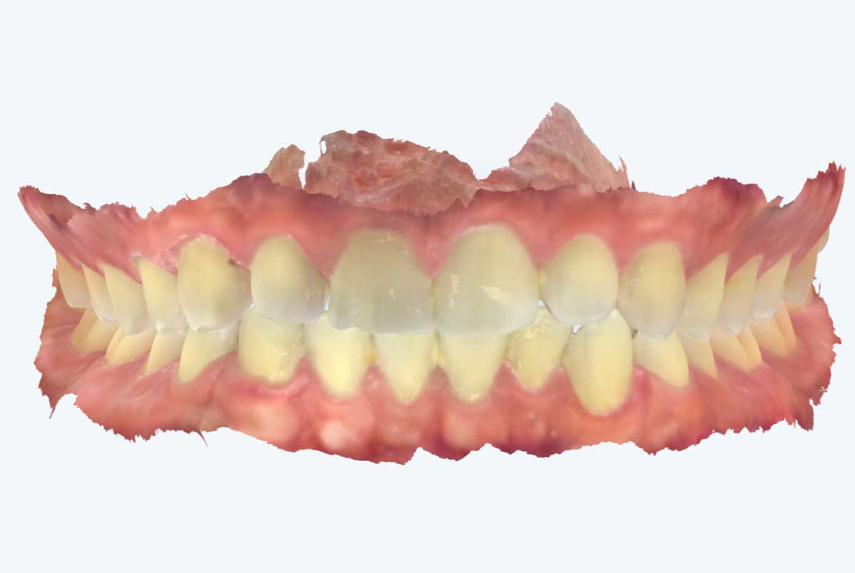 Uso do escaneamento intraoral na limpeza dental com AirFlow