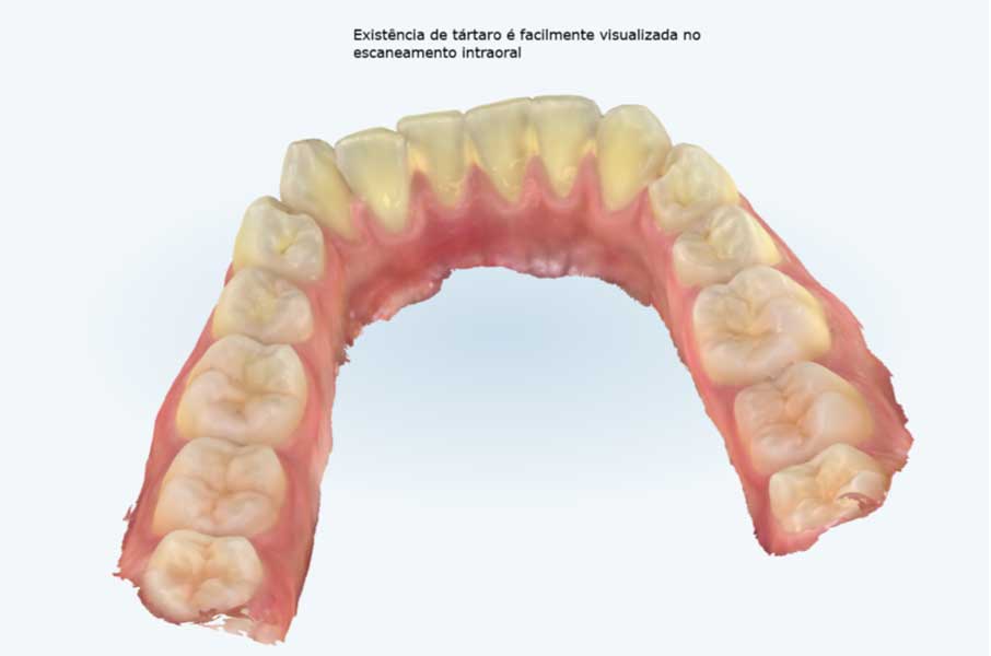 Tártaro visto do escaneamento