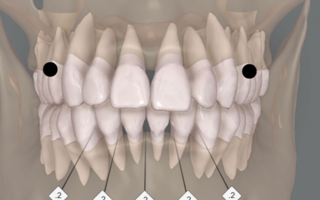 Planejamento digital integrado na ortodontia com Invisalign