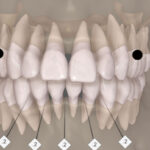 Planejamento digital integrado na ortodontia com Invisalign