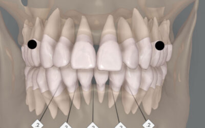 Planejamento digital integrado na ortodontia com Invisalign