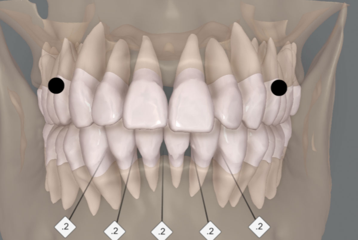 Planejamento digital integrado na ortodontia com Invisalign<br />
